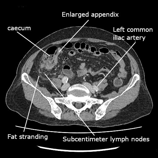 CT abdomen — acute appendicitis