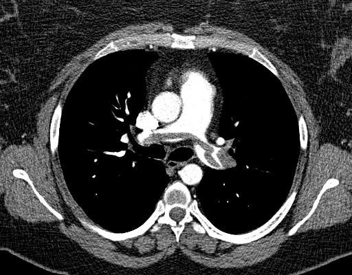 CT angiography — pulmonary embolism