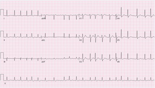 12-lead EKG — atrial fibrillation