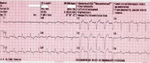 12-lead EKG — sinus tachycardia