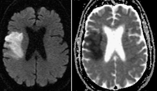 Brain MRI — acute ischemic stroke