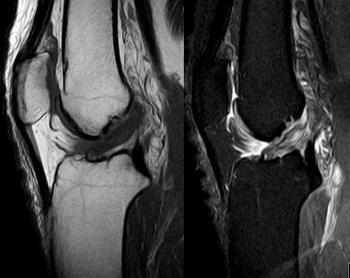 Knee MRI — ACL tear