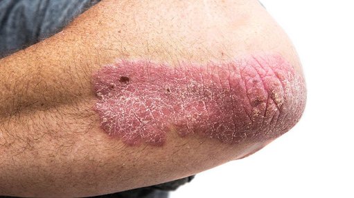 Plaque psoriasis — clinical reference