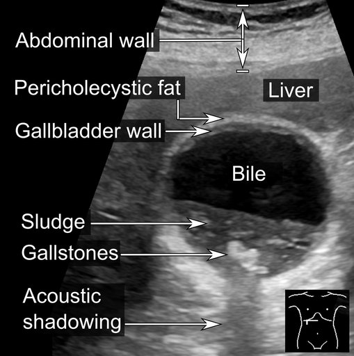 Ultrasound — gallbladder cholelithiasis