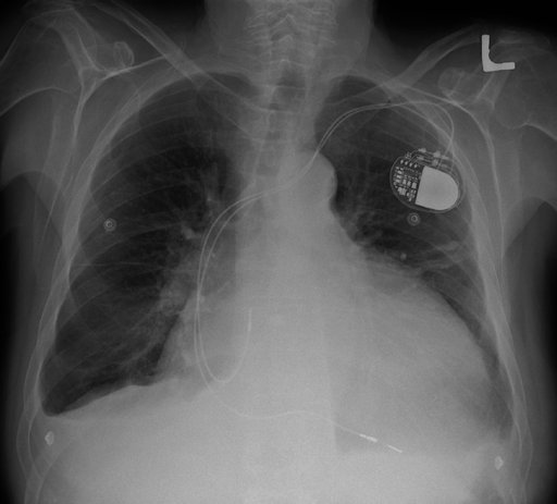 Chest X-ray — cardiomegaly